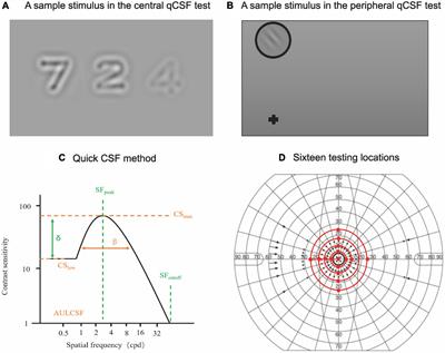 Assessing the contrast sensitivity function in myopic parafovea: A quick contrast sensitivity functions study